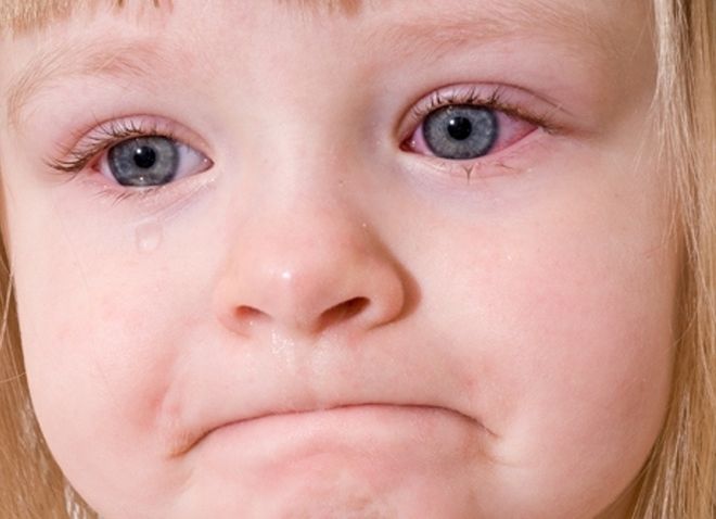 Viêm bờ mi ở trẻ cũng là nguyên nhân khiến trẻ nháy mắt liên tục