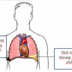 4 nhóm nguyên nhân tràn dịch màng phổi đe dọa tính mạng