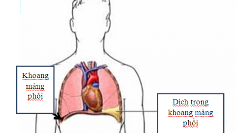 4 nhóm nguyên nhân tràn dịch màng phổi đe dọa tính mạng
