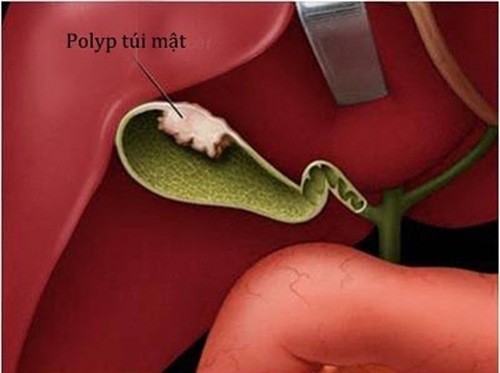 Những yếu tố nguy cơ nào có thể gây hình thành polyp túi mật?
