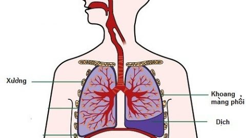 Tràn dịch màng phổi nguy hiểm không?