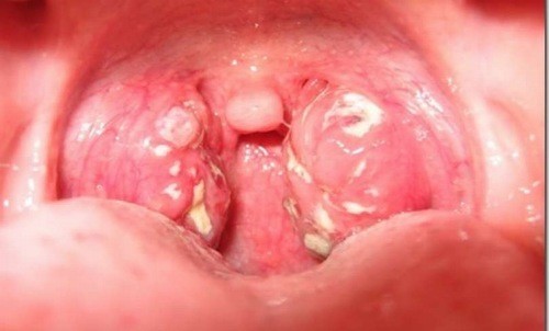 Viêm họng hạt ở lưỡi có thể tái phát không?
