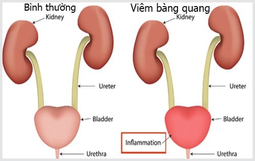 Viêm bàng quang có liên quan đến việc tiêu thụ đồ uống chứa caffein không?
