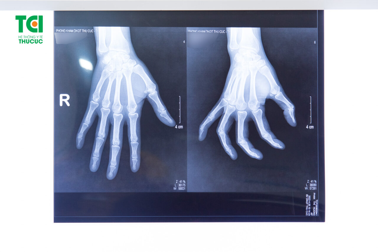 Cách điều trị gãy xương bàn tay ngón út hiệu quả là gì?
