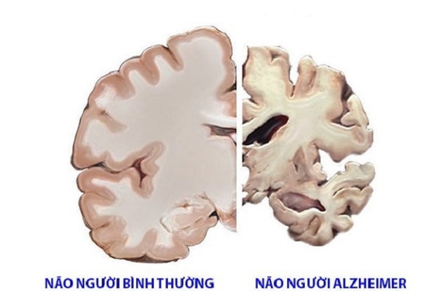 Bệnh Alzheimer là nguyên nhân chính gây suy giảm trí nhớ