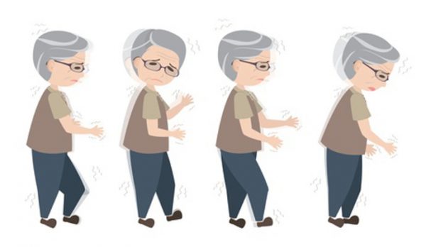 Khi mắc bệnh Parkinson, tư thế đứng của bệnh nhân dễ bị chuyển sang dạng cong hoặc có thể bị mất cân bằng.