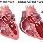 Bệnh viêm cơ tim và những điều cần biết