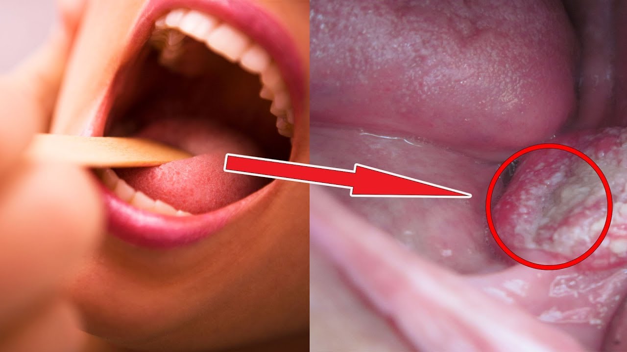 Hình ảnh ung thư vòm họng có mức độ nguy hiểm cao