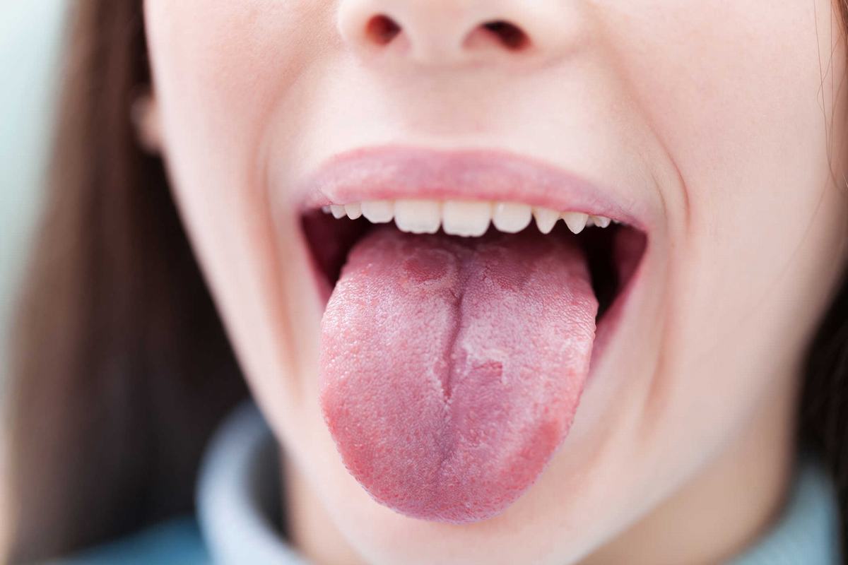 Tìm hiểu về hình ảnh lưỡi bị bệnh và giải pháp chữa trị