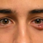 Chắp mắt: Trích sớm để tránh biến chứng