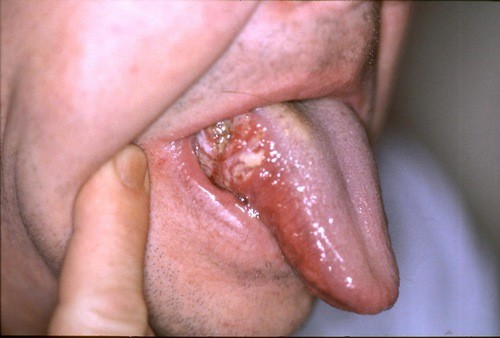 Hình ảnh ung thư lưỡi giai đoạn cuối như thế nào?