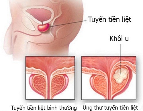 Hình ảnh tuyến tiền liệt dùng để chẩn đoán bệnh như thế nào?