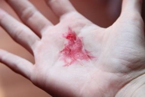 Ho ra máu – dấu hiệu của nhiều bệnh