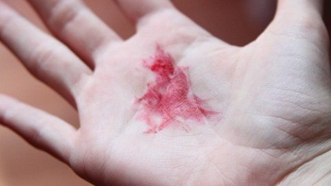 Ho ra máu có nguy hiểm không?triệu chứng thường gặp