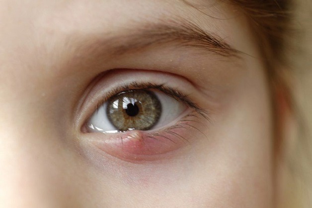 Chích lẹo mắt sớm để giữ đôi mắt khỏe mạnh bình thường