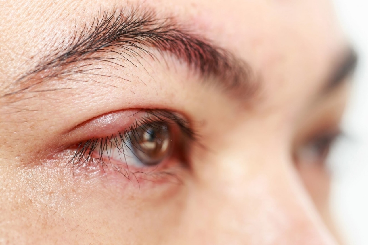  Chích lẹo mắt có đau không ? Tìm hiểu ngay để có giải pháp hiệu quả