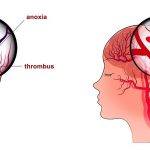 Bệnh nhồi máu não và cách điều trị
