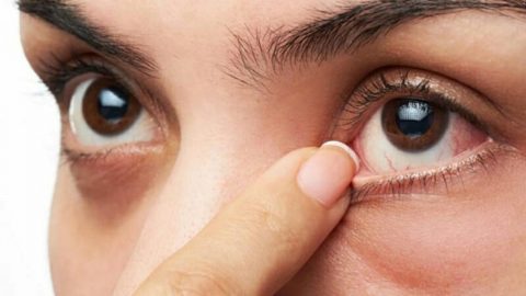 Sạn vôi ở mắt – cách nào để điều trị?