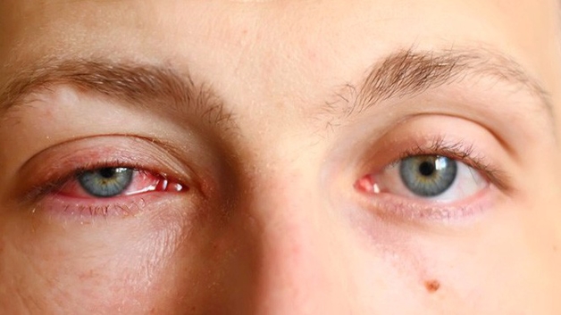 Sạn vôi ở mắt là tình trạng lắng đọng chất calci ở bên dưới lớp kết mạc sụn mi của nhãn cầu