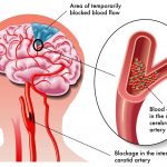 Tai biến mạch máu não và cách điều trị