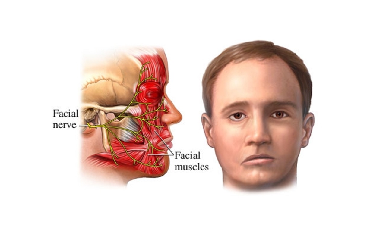 Лицевой нерв последствия. Посттравматическая нейропатия лицевого нерва. Воспаление лицевого нерва. Повреждение тройничного нерва.