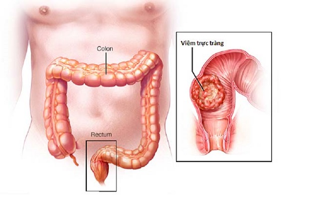 Các triệu chứng viêm trực tràng