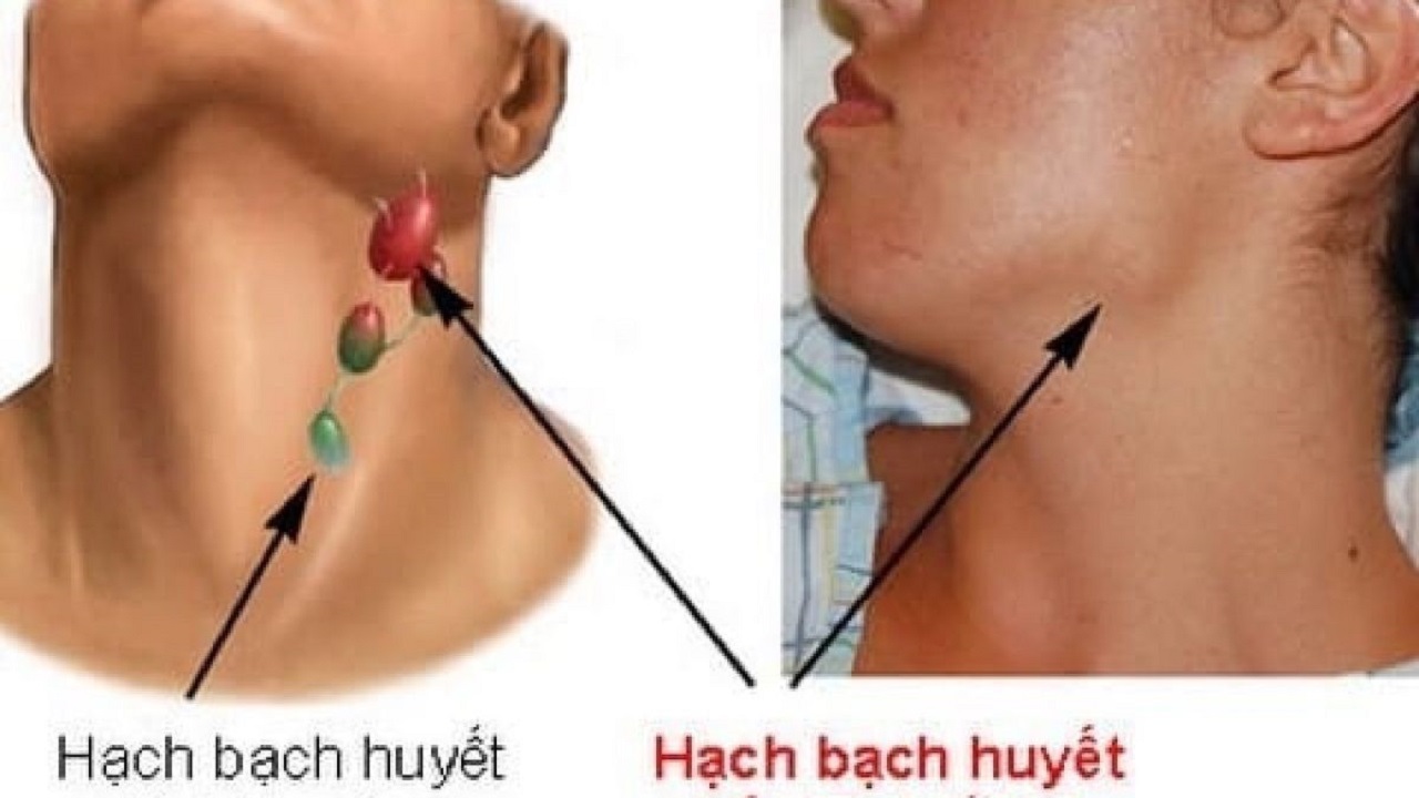 Khả năng sống sót và tỷ lệ hồi phục của bệnh nhân ung thư hạch bạch huyết như thế nào?
