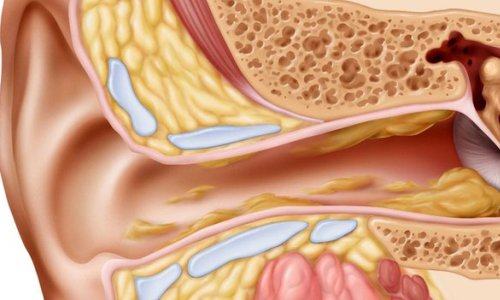 Các yếu tố nguy cơ nào có thể góp phần vào sự phát triển của polyp tai giữa?
