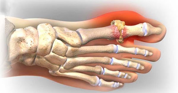 Người bị bệnh gút có cảm giác nóng ở khớp không?