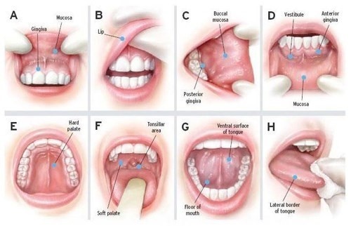 Trong ung thư khoang miệng, khối u có xuất hiện ở nhiều vị trí trong miệng như lưỡi, niêm mạc miệng...