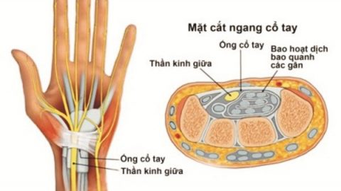 Điều trị hội chứng ống cổ tay: không thể chậm trễ