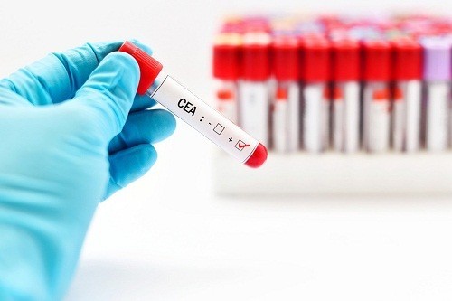 Cần phải chuẩn bị gì trước khi xét nghiệm định lượng CEA máu?