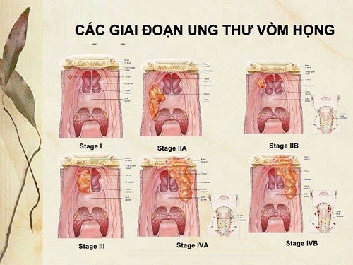 Hình ảnh ung thư vòm họng giai đoạn đầu như thế nào?