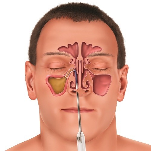 Phẫu thuật nội soi mũi xoang và những điều bạn cần biết