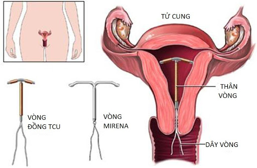 Sau Khi Tháo Vòng Tránh Thai Uống Thuốc Gì: Hướng Dẫn An Toàn Và Hiệu Quả