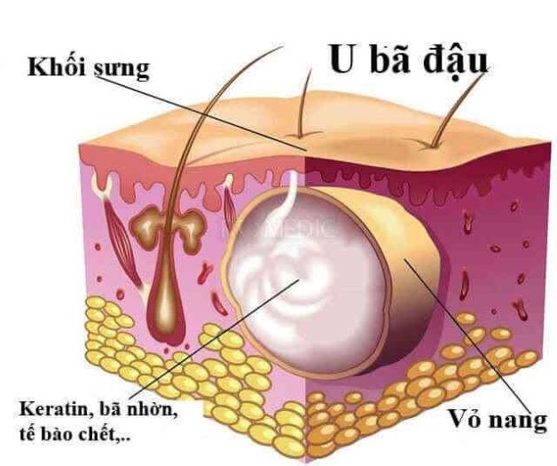 Triệu chứng và cách điều trị u bã đậu ở mông có hiệu quả?