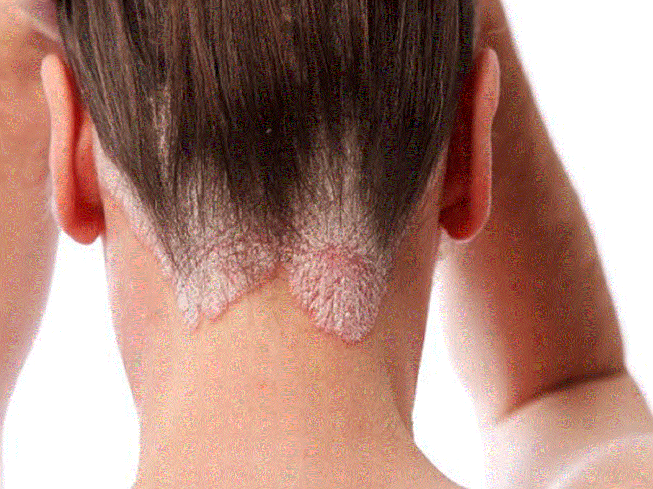 Làm thế nào để ngăn ngừa viêm chân tóc tái phát?
