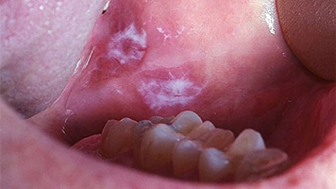 Những điều cần biết về ung thư khoang miệng