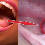 Dấu hiệu ung thư khoang miệng chảy máu bất thường