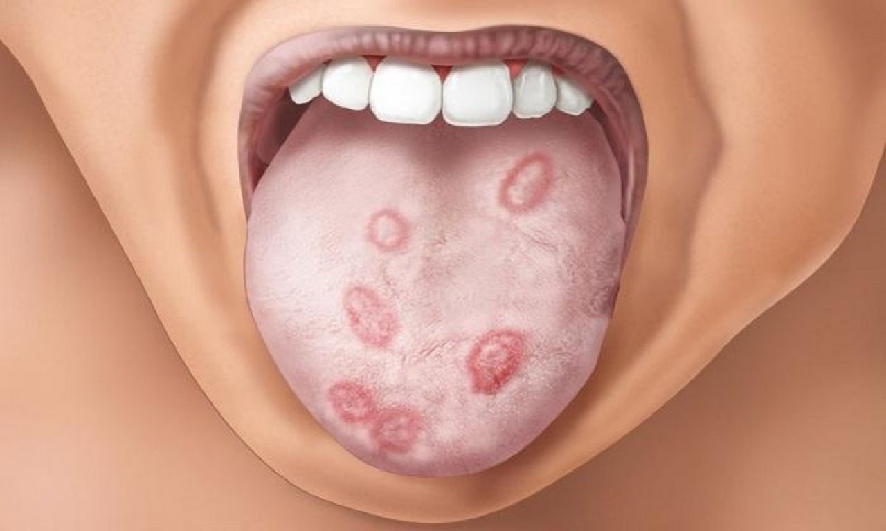 Bệnh giang mai ở miệng có triệu chứng gì? 
