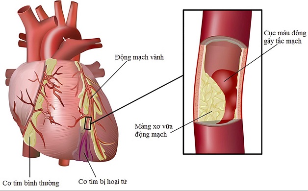 Hội chứng mạch vành cấp gồm 2 dạng là cơn đau thắt ngực ổn định và nhồi máu cơ tim.