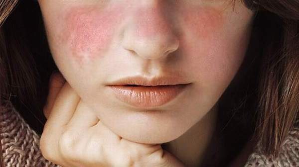 Các yếu tố bên ngoài như thuốc, hoocmon, viêm nhiễm,... cũng tác động không nhỏ đến sự phát triển của lupus ban đỏ