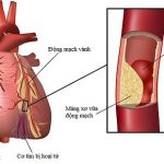 Những điều cần biết về bệnh hẹp mạch vành tim