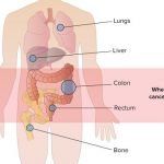 Ung thư tuyến giáp di căn sống được bao lâu?
