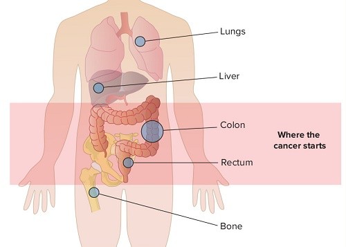 Tiên lượng của ung thư tuyến giáp di căn ra sao?
