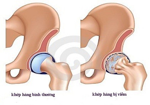 Làm thế nào để chẩn đoán viêm khớp háng ở người lớn?
