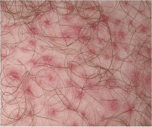 Viêm nang lông vùng kín – Nguyên nhân và cách xử trí