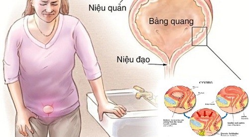 Bệnh viêm niệu đạo có thể ảnh hưởng đến khả năng sinh sản của nam giới không?
