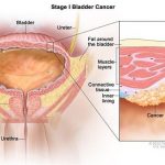 Các giai đoạn của ung thư bàng quang