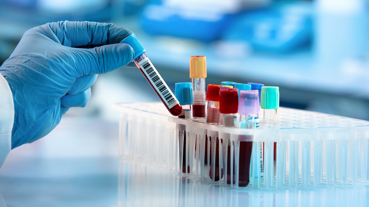 Làm thế nào để chuẩn bị cho việc xét nghiệm chỉ số LYM trong máu?
